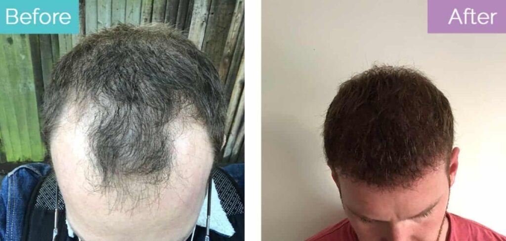 12 months after 3000 grafts hair transplant