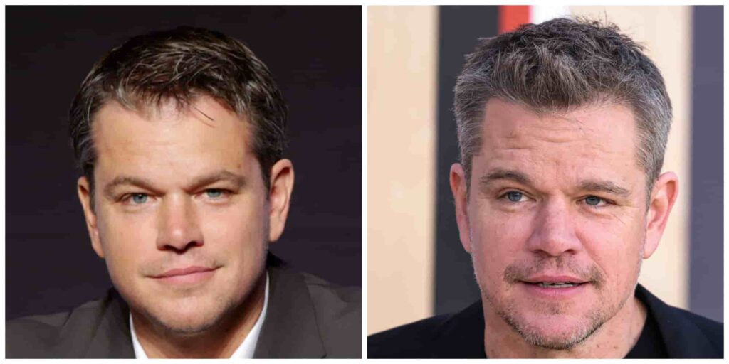 Matt Damon before and after alleged hair transplant