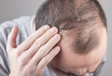 hair transplantation without complete hair loss