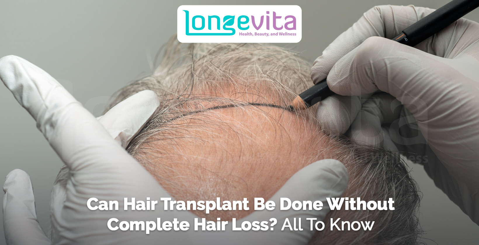 doctor marking hairline on scalp with thinning hair before transplant