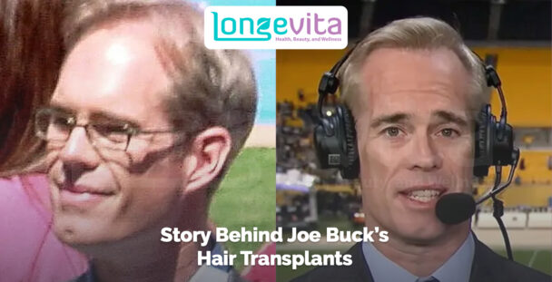 Side-by-side images of Joe Buck before and after hair transplants with broadcast headset
