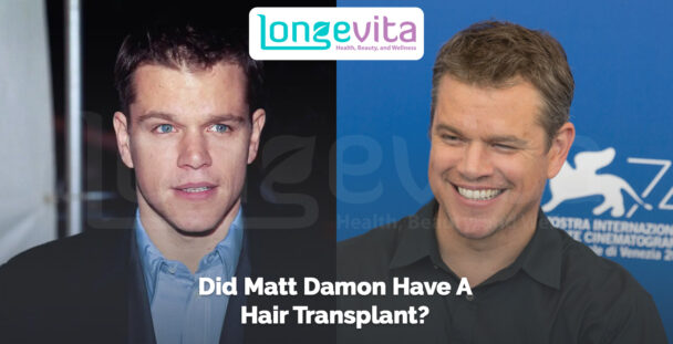side-by-side images of Matt Damon with different hairstyles and headline about hair transplant