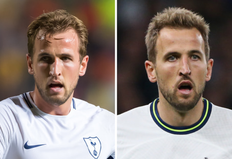 Harry Kane before and after hair transplant