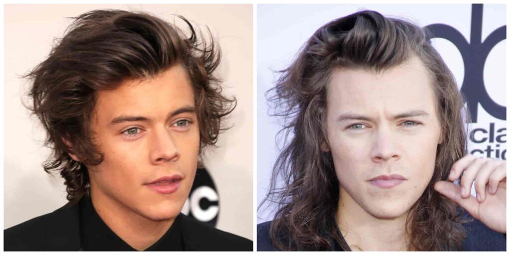 Harry Styles hair loss before and after
