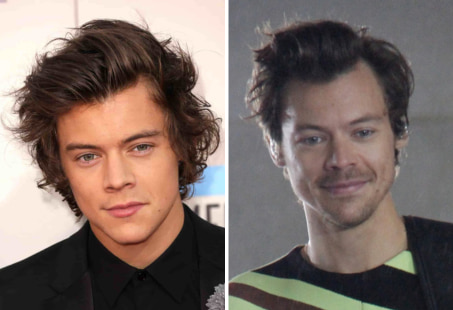 Harry Styles hair transplant