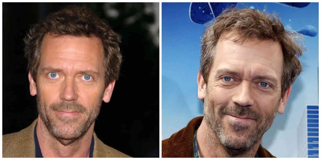 Hugh Laurie hairline recession