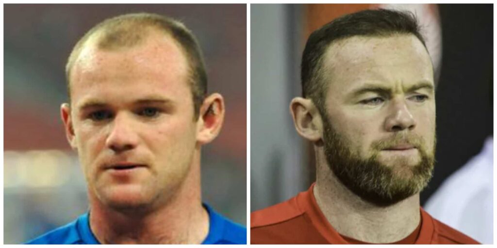 Wayne Rooney before and after hair transplant