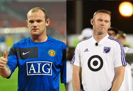 wayne rooney before and after hair transplant 