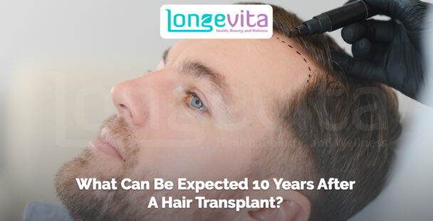 man having hairline marked before transplant with text about long-term results