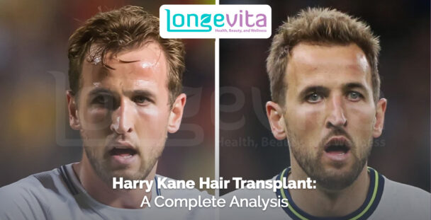 side-by-side images of Harry Kane with different hairstyles and headline about hair transplant analysis