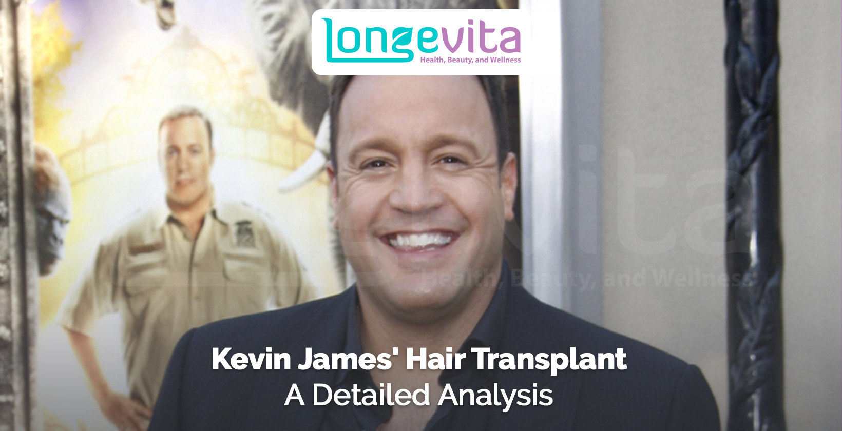 Kevin James smiling at event with headline about detailed hair transplant analysis