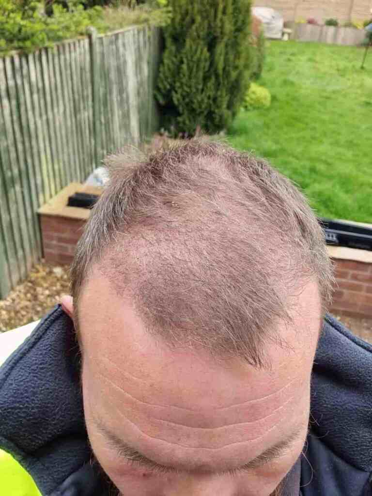 1 month after hair transplant