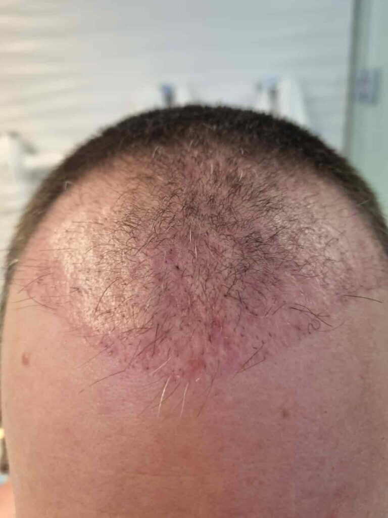2 months after hair transplant