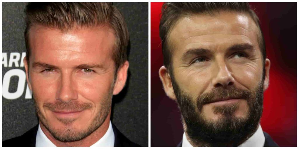 David Beckham alleged beard transplant