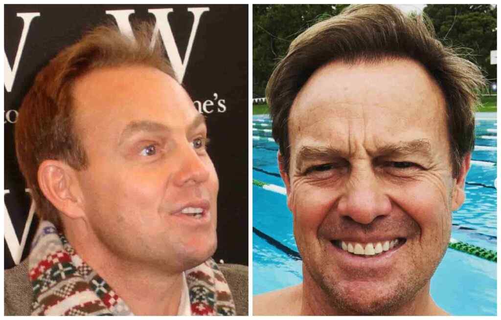 Jason Donovan before and after hair transplant