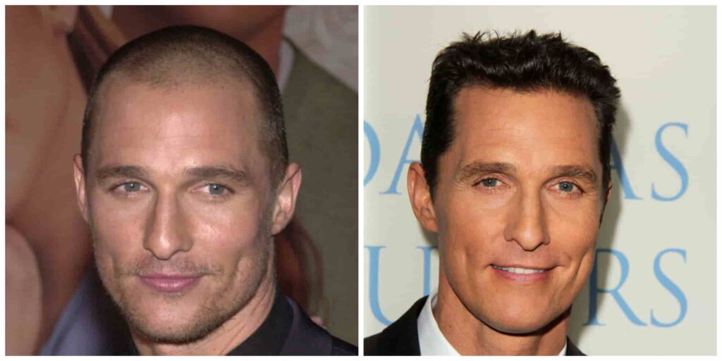 Matthew McConaughey alleged hair transplants