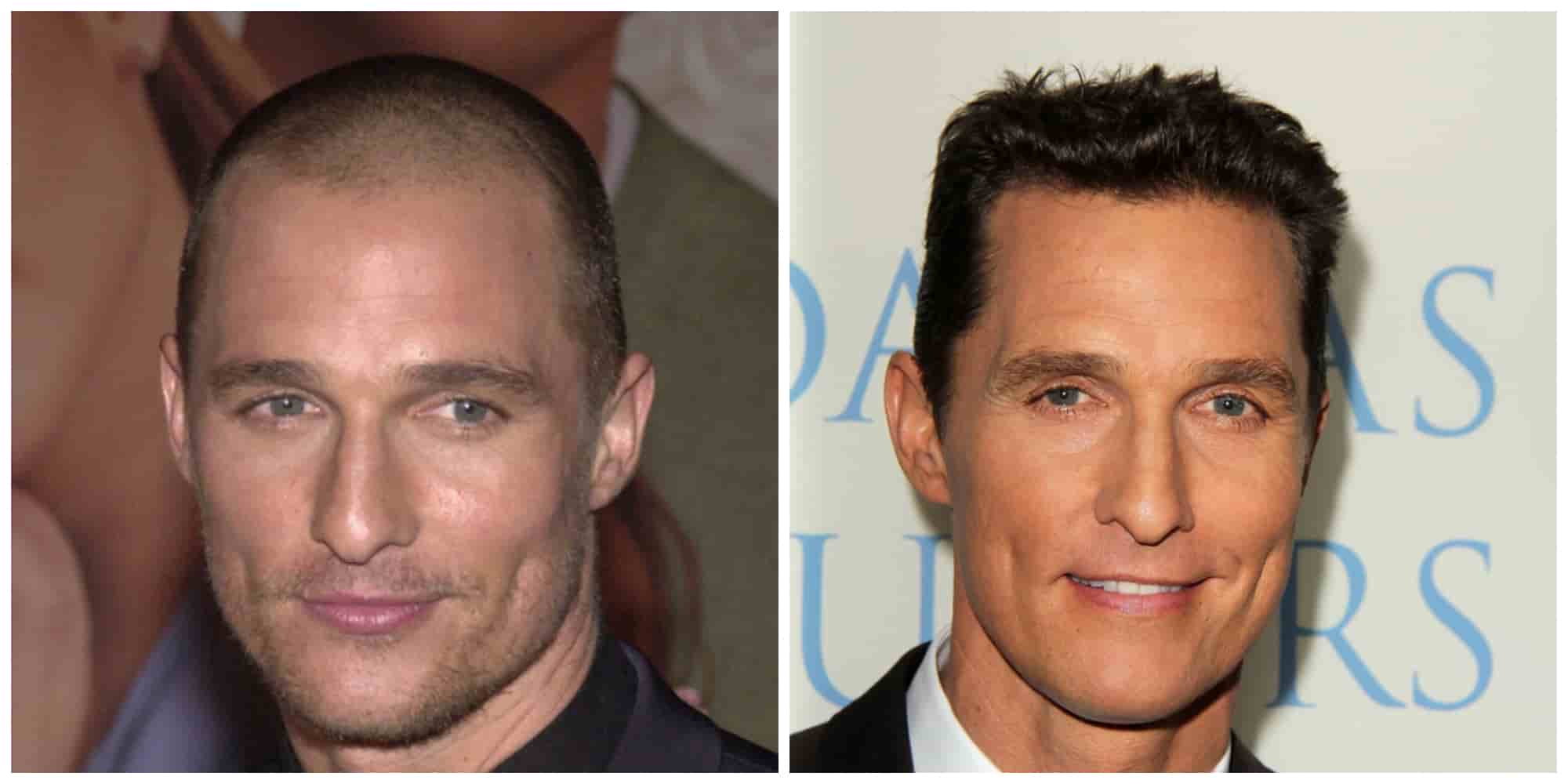 Matthew McConaughey Hair Transplant: The Truth Revealed