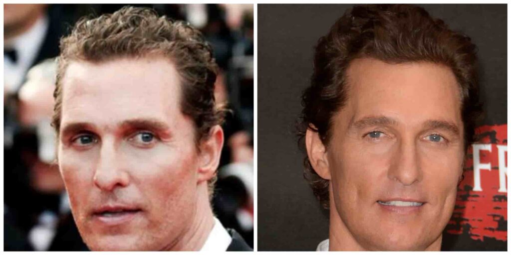 Matthew McConaughey before and after alleged hair transplant