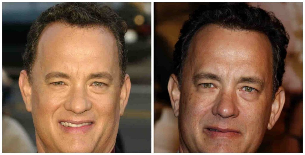 Tom Hanks second alleged hair transplant