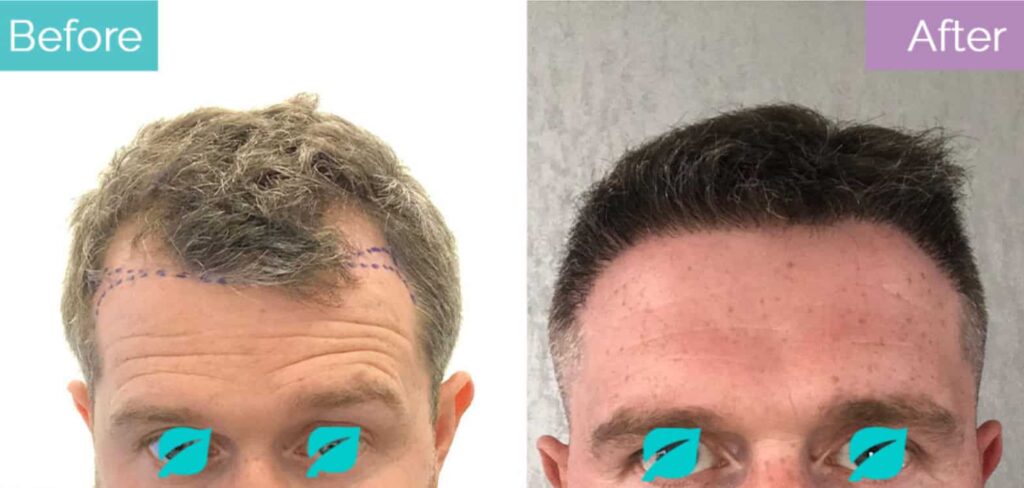grey to black hair after transplant