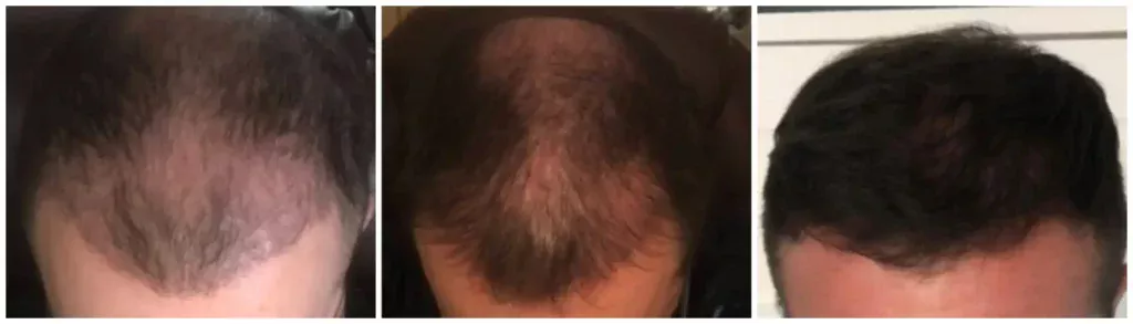 Hair transplant results