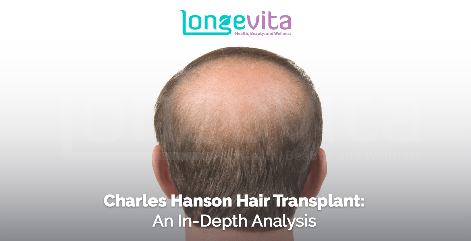 back view of a balding man’s head with headline about Charles Hanson hair transplant analysis