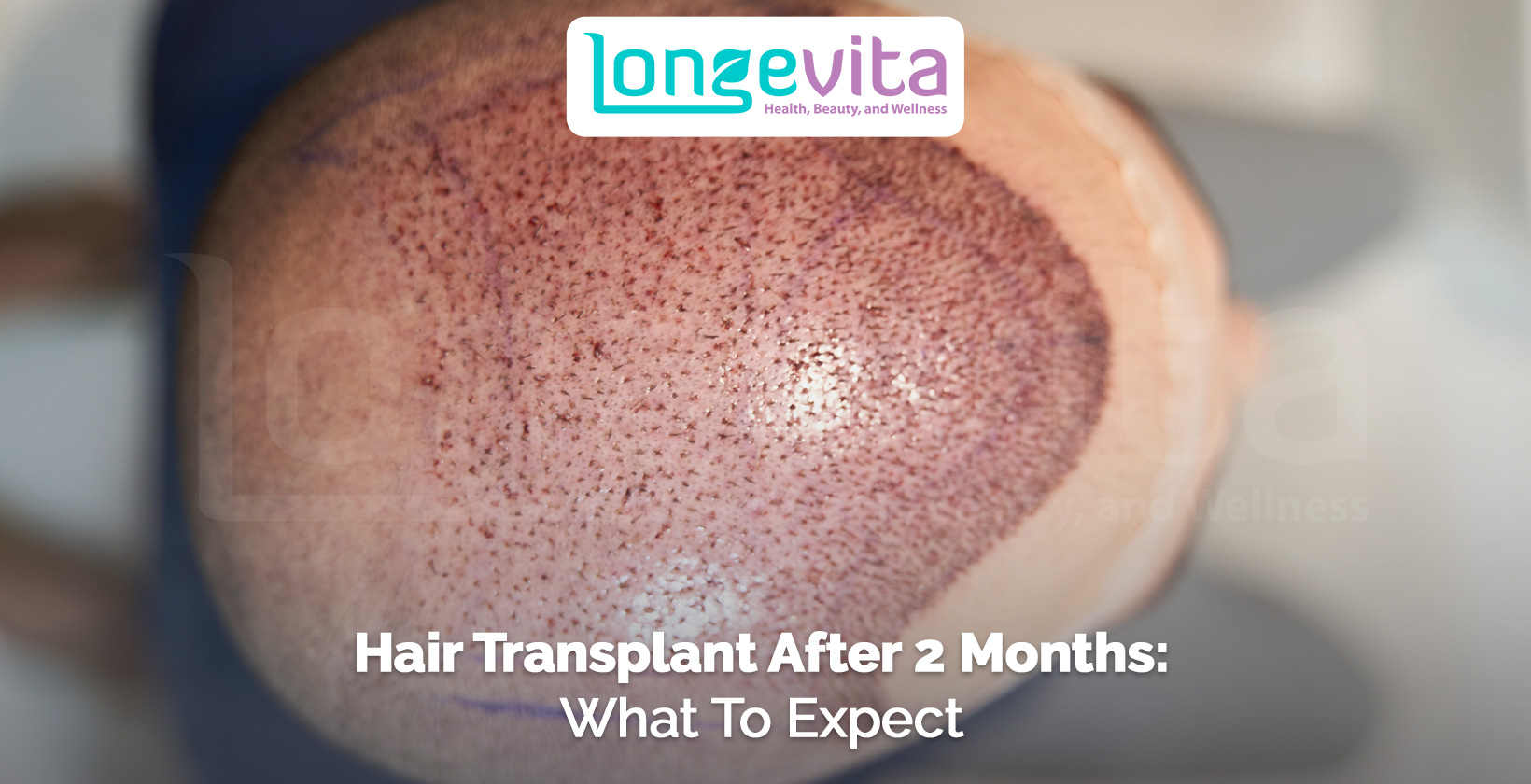 close-up of scalp showing hair growth two months after transplant