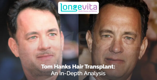 side-by-side images of Tom Hanks showing hair changes with headline about hair transplant analysis