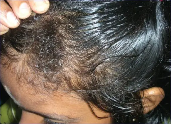 woolly hair nevus