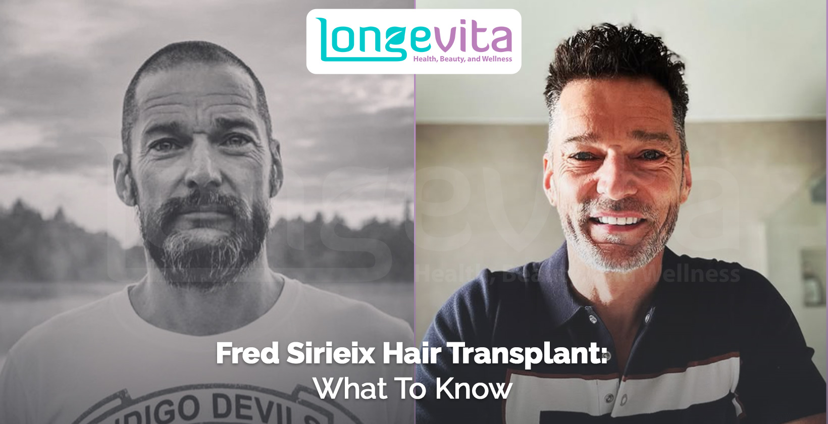 side-by-side photos of Fred Sirieix showing hair changes with headline about transplant information