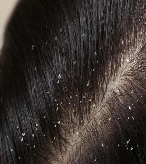 Dandruff
