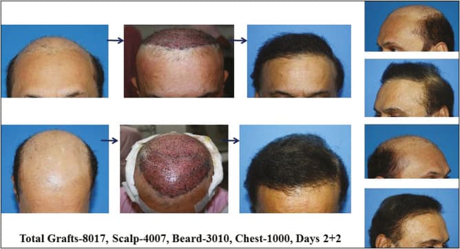 8000 grafts hair transplant result