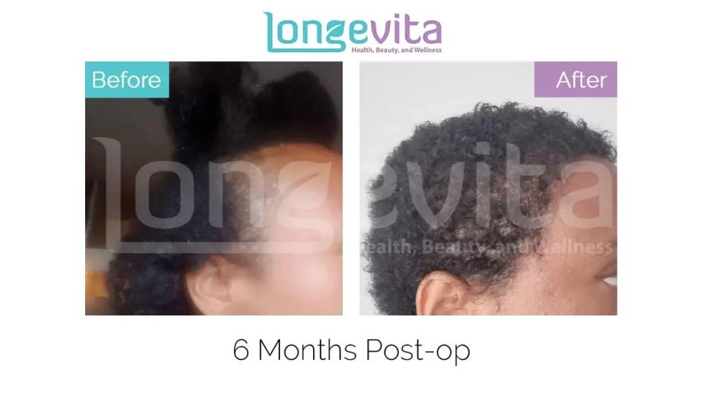 afro hair transplant turkey before after