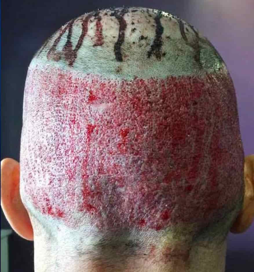 aggressive overharvesting of donor area