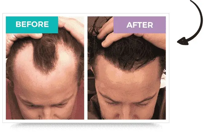 Minoxidil finasteride discount
