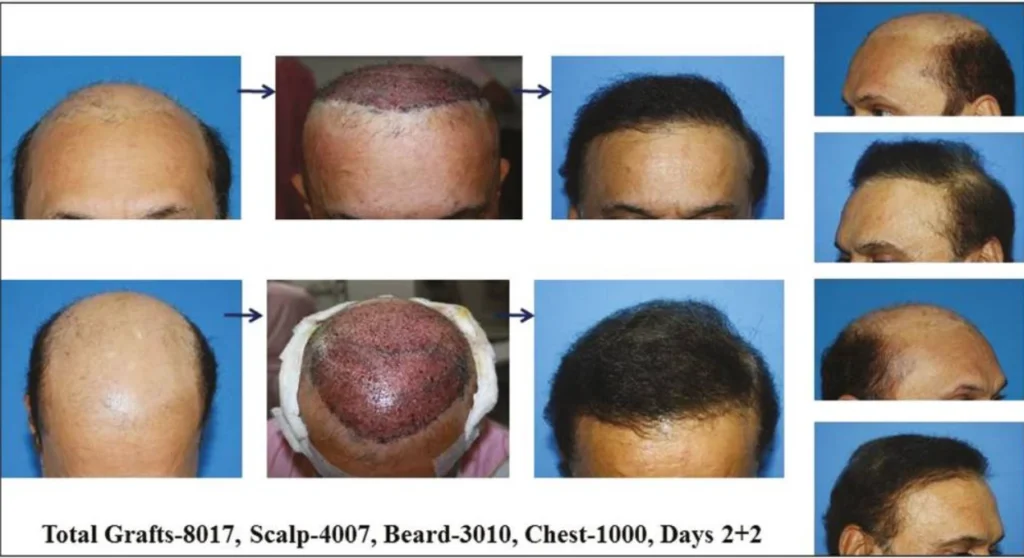 8000 Grafts Hair Transplant