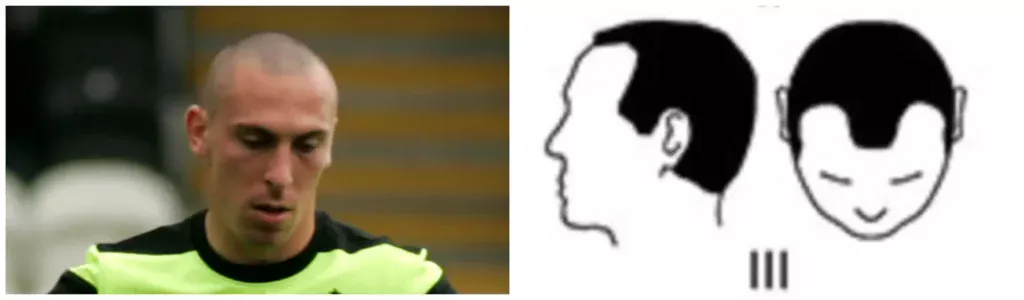 Scott Brown receded temples