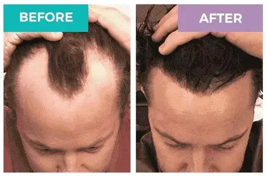 hair transplant before and after