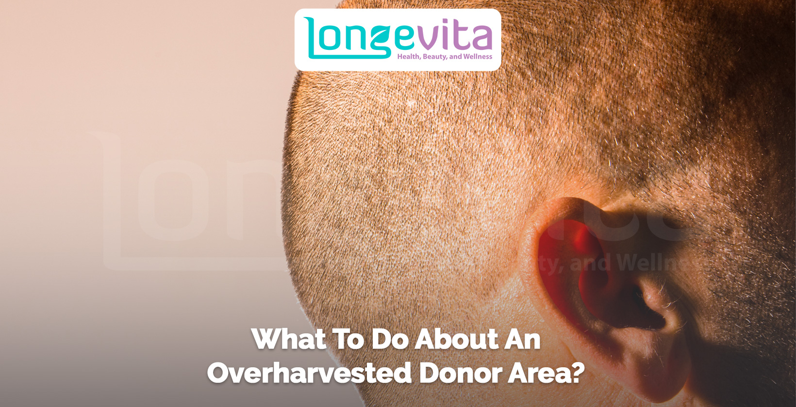 close-up of scalp showing signs of overharvesting after hair transplant surgery