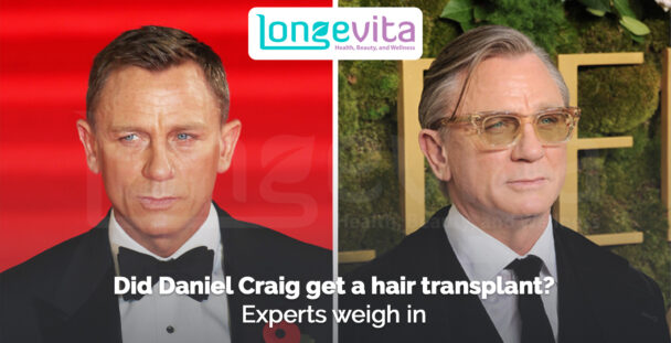 side-by-side photos of Daniel Craig with headline questioning a hair transplant