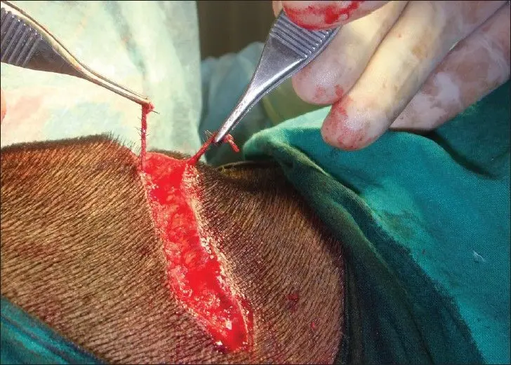 fut hair transplant 2