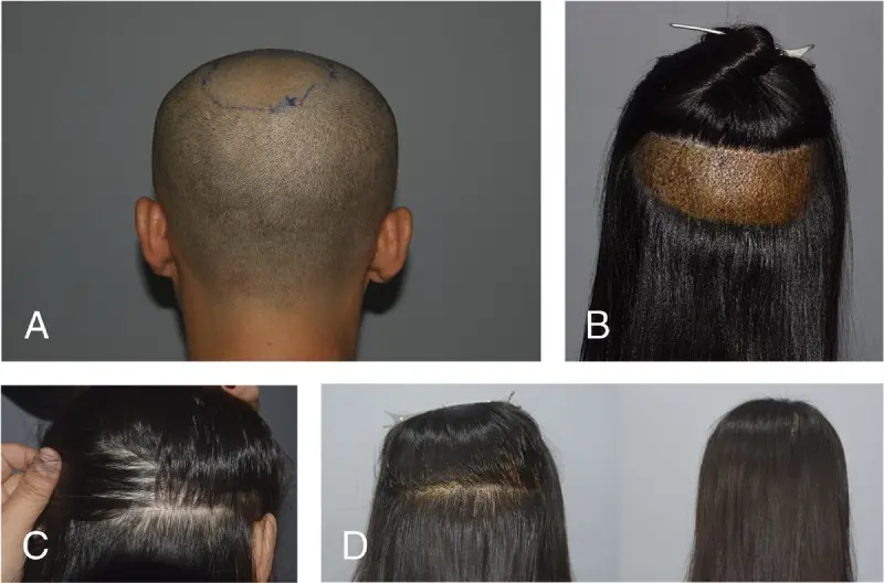 unshaven hair transplant