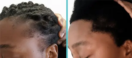 Before and after results of Afro hair transplant using FUE technique