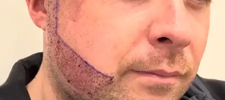Close-up of a male patient after beard transplant with implanted grafts and marked beard line