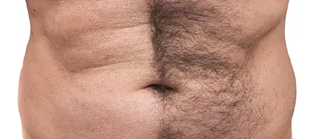 Male torso showing chest hair as a potential donor area for body hair transplant – informational only