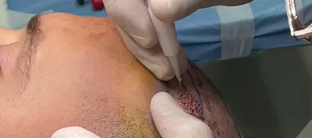 Direct Hair Implantation technique using implanter pen for precise hairline restoration