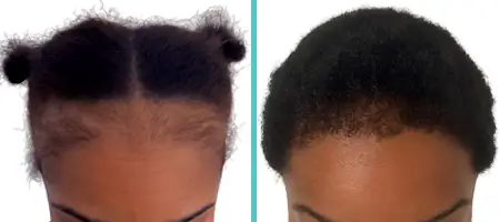 Frontal hair thinning in a female patient before hair transplant with Afro-textured hair
