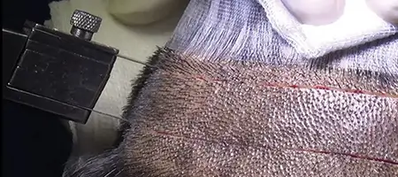 FUT hair transplant strip method and scar location