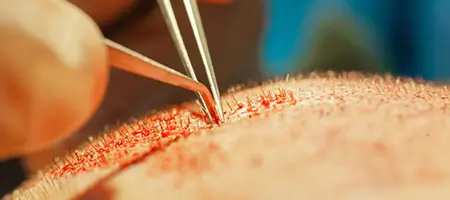 Close-up of grafts being implanted during a FUT hair transplant showing linear incision site