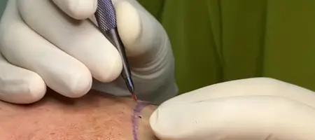 Hair transplant using sapphire blade for high-precision incisions during FUE procedure